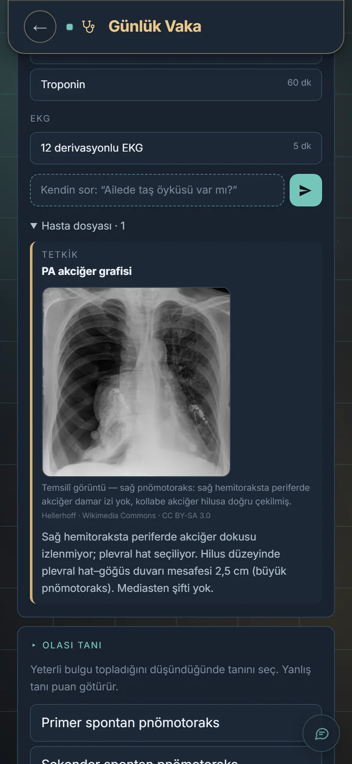 PA akciğer grafisi: sağ pnömotoraks görüntüsü ve radyolojik yorum